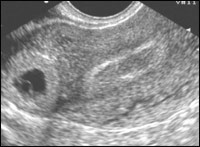 Эхографические признаки эктопической беременности следующие  2