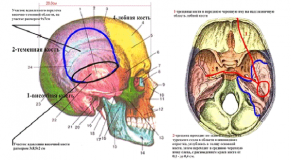 Переломы черепа и позвоночника 1